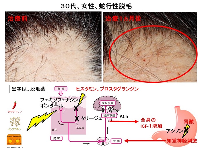 円形脱毛症　病院